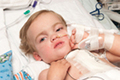 世界最年少，2歳児に人工肺